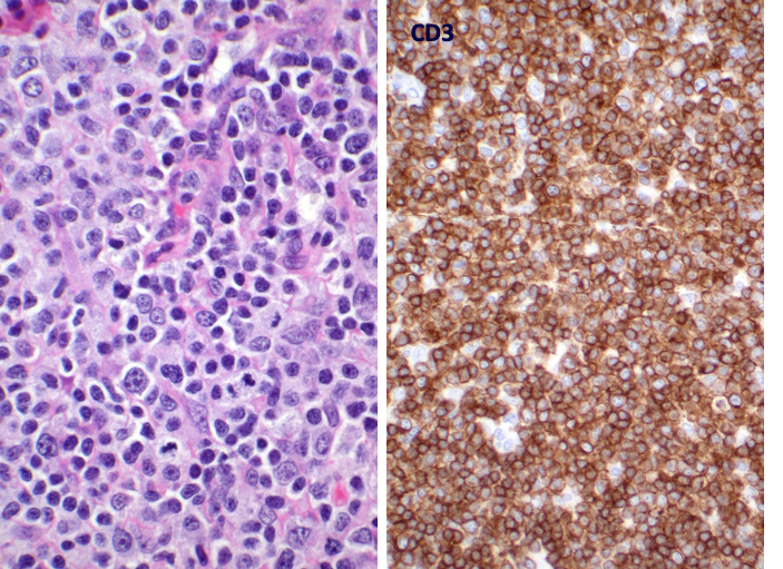 brent_tan's tweet photo. Autoimmune lymphoproliferative syndrome (ALPS)
▶Follicular hyperplasia ± PTGC ± regressed follicles
▶Prominent paracortical hyperplasia by polyclonal αβ T-cells: CD3+CD4-CD8-CD45RA+CD45RO- with high proliferation and CD57+, TIA+, perforin+ 
▶Polyclonal plasmacytosis https://t.co/Exg4DjP3k9