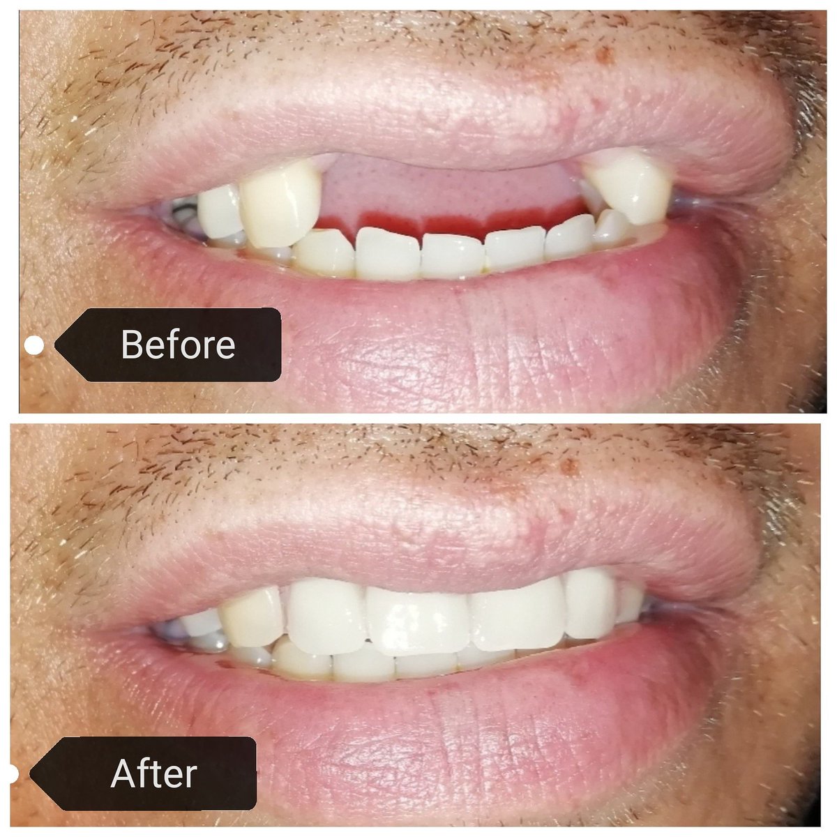 dennehofdentist's tweet photo. #before #after #beforeandafter #dentist #capetown #DennehofDentistry #open7days https://t.co/xiluGoS4CS