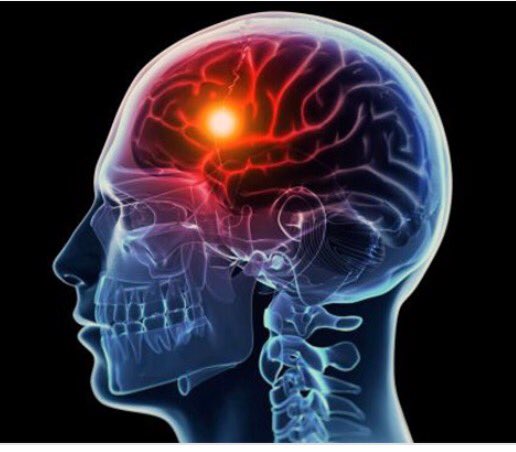 ChagaOrganics's tweet photo. You are twice as likely to have a #stroke if you have #cvd (#heartdisease). #Chaga has #antioxidants which lower #bloodpressure and aid #cardiovascularfunction, relaxing blood vessels  &amp; improving flow, delivering more oxygen throughout the body #lukeperry #riplukeperry https://t.co/dZeWJvq9vm