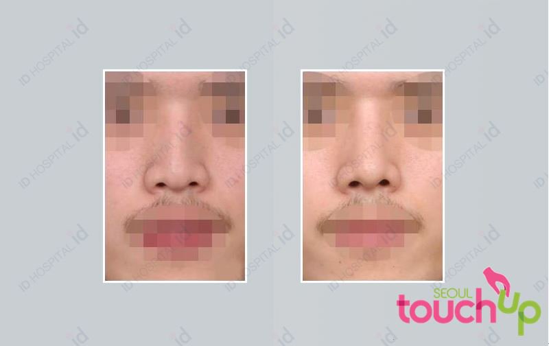 SeoulTouchUp's tweet photo. Check out this before and after photos from one of our patients.

https://t.co/2bVYQSEMSP   

#seoultouchup #seoultouchup_reviews #rhinoplasty #nosejob #plasticsurgeryinkorea #plasticsurgeryresults #plasticsurgeryreviews  #koreanplasticsurgery #nosesurgery #beautifulnose https://t.co/Kx9hl7qJAv