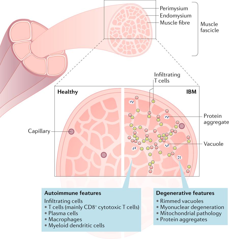 Find out all about the clinical features and #pathogenesis of inclusion body #myositis in our new #Review!
Read it for #free here rdcu.be/bpxyB #SharedIt