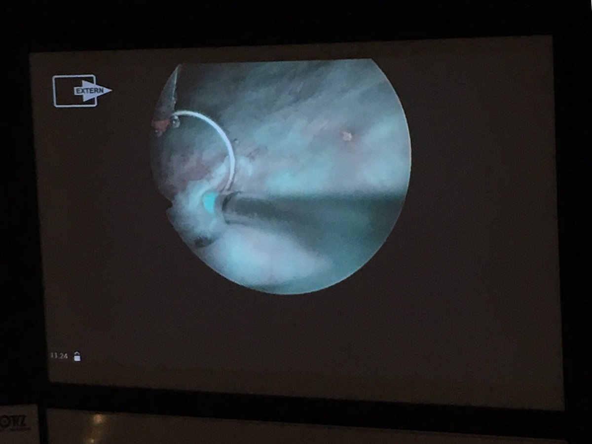 OlympusUrology's tweet photo. Bernard Malavaud performing En bloc Resection using #NBI and #PLASMA during #esunmibc19 @UrowebESU https://t.co/QlXmLcbaFq