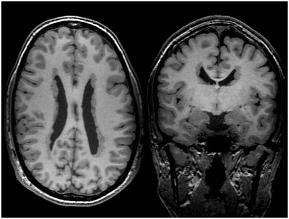 EpilepsiaRuber's tweet image. Las heterotopias nodulares periventriculares son un tipo de malformación del desarrollo cortical  que causan epilepsia fármacorresistente. En esta RM T1  podemos ver los nódulos de sustancia gris ectópica en la pared de los ventrículos cerebrales.

#Epitecaproject #Neuroteaching