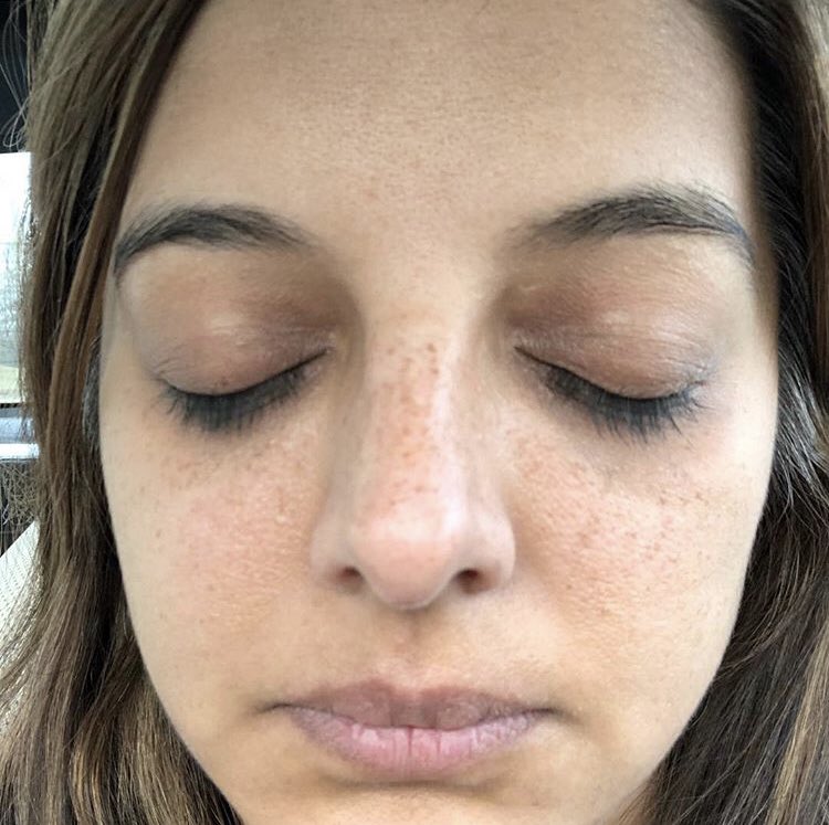 MariwallaDerm's tweet photo. Before; Check out our instastory today to watch Dr. Mariwalla’s experience with microneedling with PRP! 

#vampirefacial #watchmework #beautyprep #Microneedling #PRP #PRPfacial #PlateletRichPlasma  #mdderm #MariwallaDermatology #ExpertSkincare #Dermatologist #derm #SkincareTips https://t.co/Um7nJRwAsJ