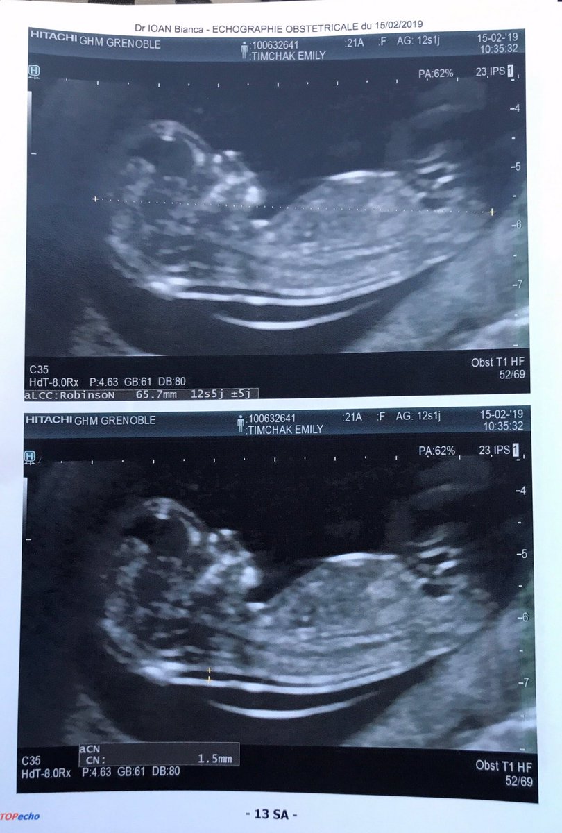 Emily Timchak Surprise We Are Super Happy To Announce That We Are Having A Baby Regarde Moi Mon Petit Bebe Chou Already So Perfect 14weeks T Co Nvzw4vgkqp