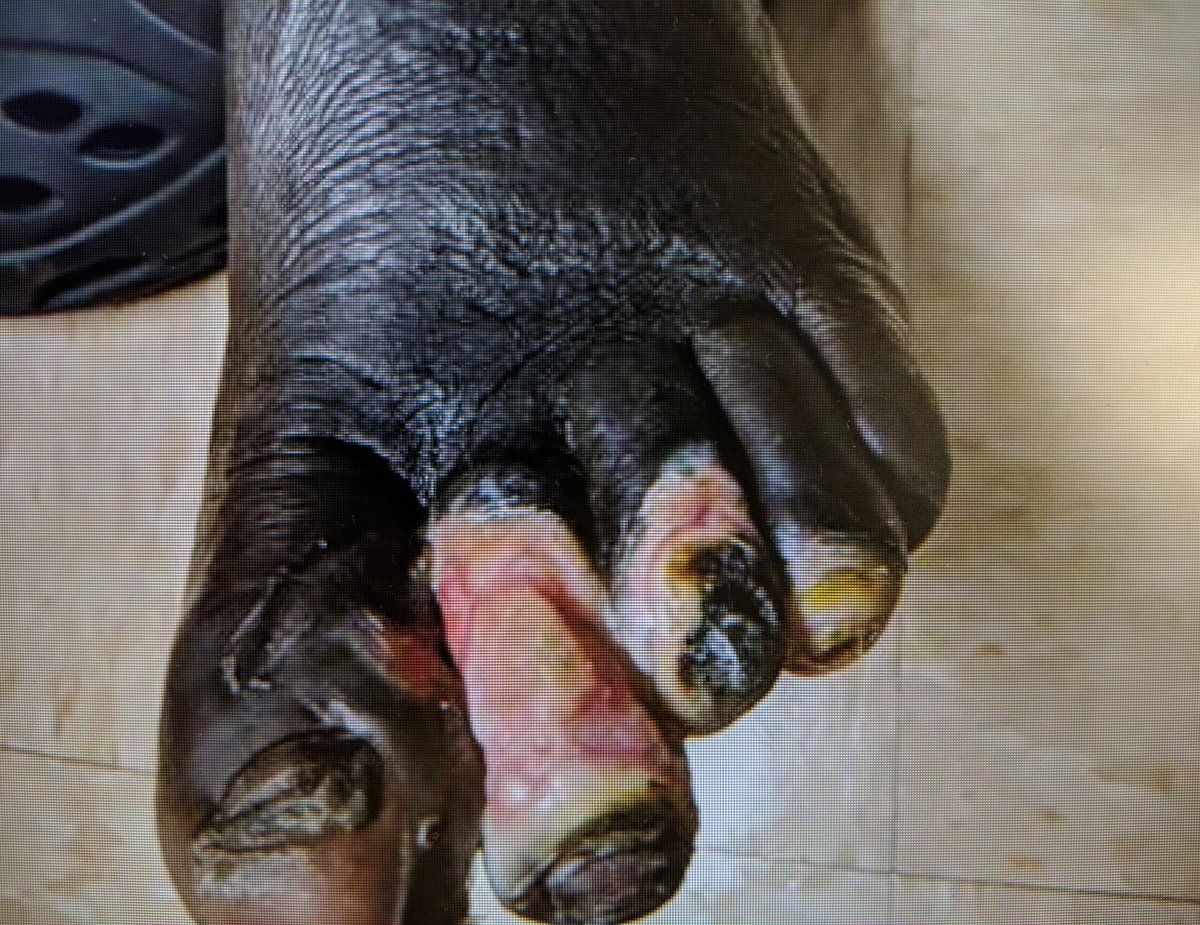 SOBE_Vascular's tweet image. Great day for 3 vessel runoff and a complete pedal plantar loop. RC5 L 2-4 toe #CLI after degloving injury. #CSI @belzerj @AbbottGlobal #commandwire @CLI_Global @CLIfighters #CLIfighters @FadiSaab17 @Mustapja @SIRspecialists @SIRRFS @SIR_ECS @SriniTummala @kmadass @BOlivieriMD