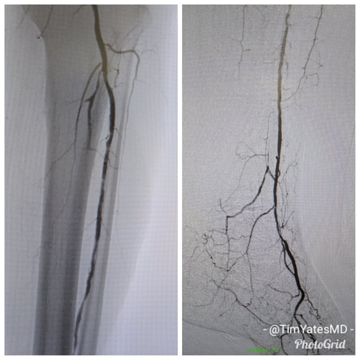 SOBE_Vascular's tweet image. Great day for 3 vessel runoff and a complete pedal plantar loop. RC5 L 2-4 toe #CLI after degloving injury. #CSI @belzerj @AbbottGlobal #commandwire @CLI_Global @CLIfighters #CLIfighters @FadiSaab17 @Mustapja @SIRspecialists @SIRRFS @SIR_ECS @SriniTummala @kmadass @BOlivieriMD