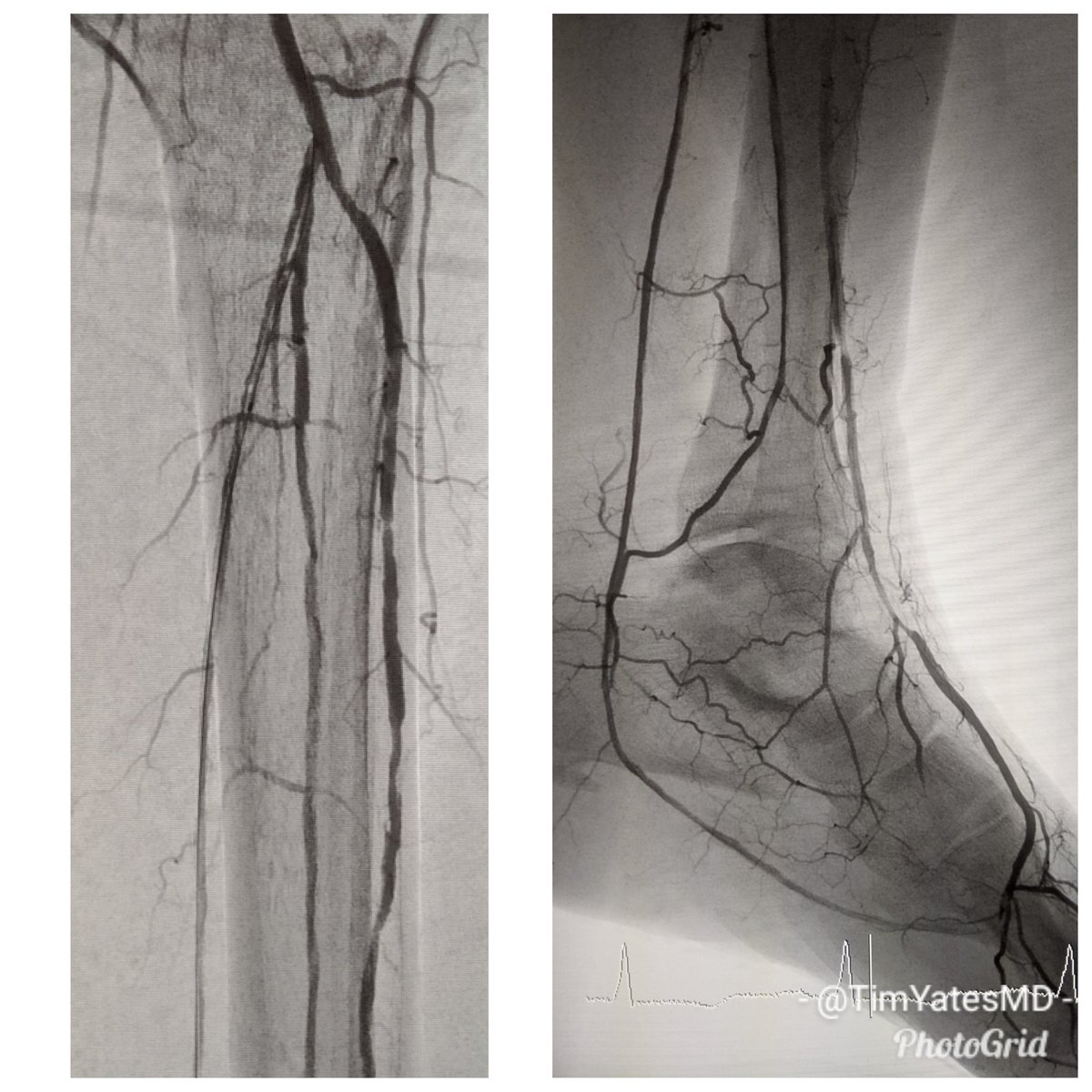 SOBE_Vascular's tweet image. Great day for 3 vessel runoff and a complete pedal plantar loop. RC5 L 2-4 toe #CLI after degloving injury. #CSI @belzerj @AbbottGlobal #commandwire @CLI_Global @CLIfighters #CLIfighters @FadiSaab17 @Mustapja @SIRspecialists @SIRRFS @SIR_ECS @SriniTummala @kmadass @BOlivieriMD