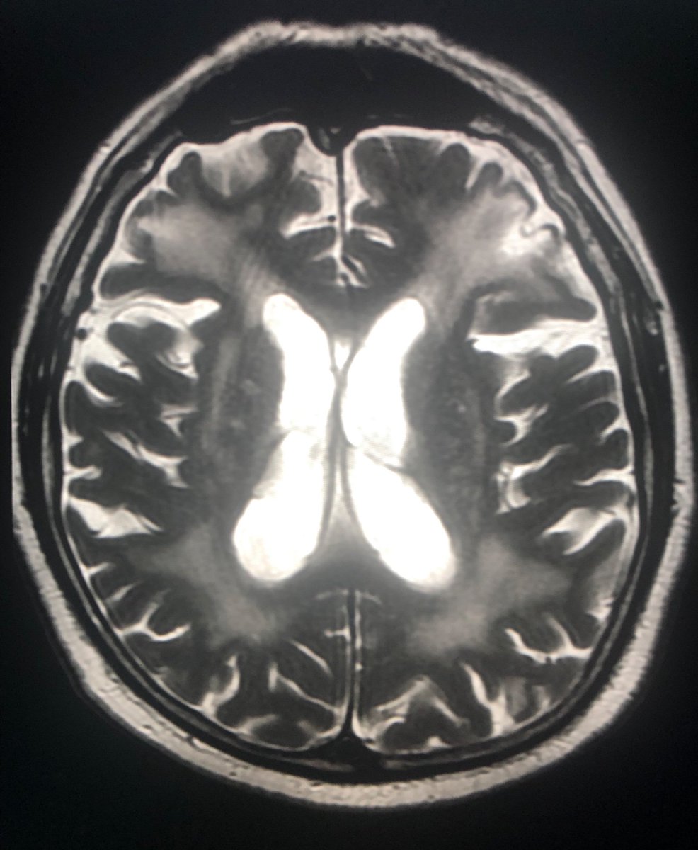 亜急性硬化性全脳炎 Hashtag On Twitter