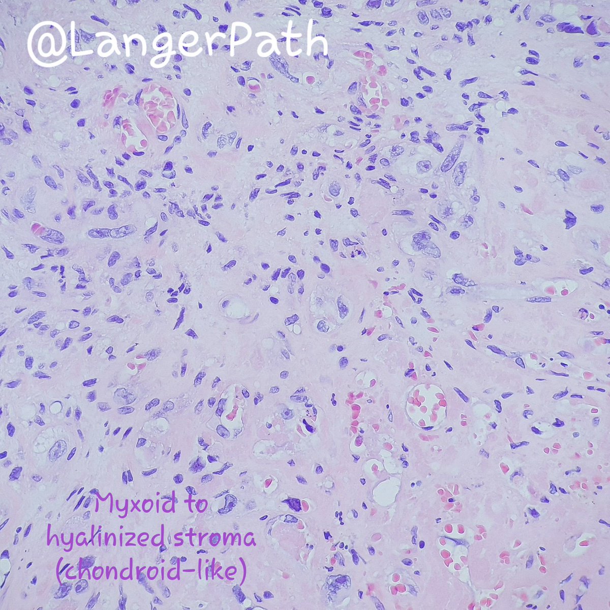 LangerPath's tweet photo. EPITHELIOID HAEMANGIOENDOTHELIOMA
Citologyc atypia and mitosis are limited, but in some cases, they can be significant and/or numerous. In these instances, the miyxo-hyaline stroma helps distingish EH from high grade angiosarcoma.
#pathology #bonepath #PathTweetorial @AlbaLarrea7 https://t.co/622eMH64OQ