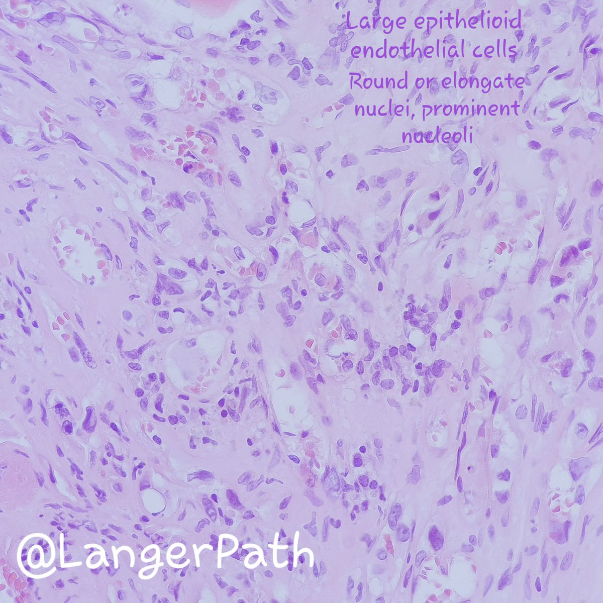 LangerPath's tweet photo. EPITHELIOID HAEMANGIOENDOTHELIOMA
Citologyc atypia and mitosis are limited, but in some cases, they can be significant and/or numerous. In these instances, the miyxo-hyaline stroma helps distingish EH from high grade angiosarcoma.
#pathology #bonepath #PathTweetorial @AlbaLarrea7 https://t.co/622eMH64OQ