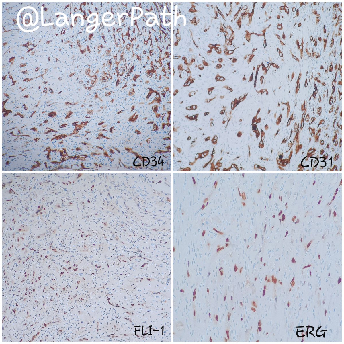 LangerPath's tweet photo. EPITHELIOID HAEMANGIOENDOTHELIOMA
Citologyc atypia and mitosis are limited, but in some cases, they can be significant and/or numerous. In these instances, the miyxo-hyaline stroma helps distingish EH from high grade angiosarcoma.
#pathology #bonepath #PathTweetorial @AlbaLarrea7 https://t.co/622eMH64OQ