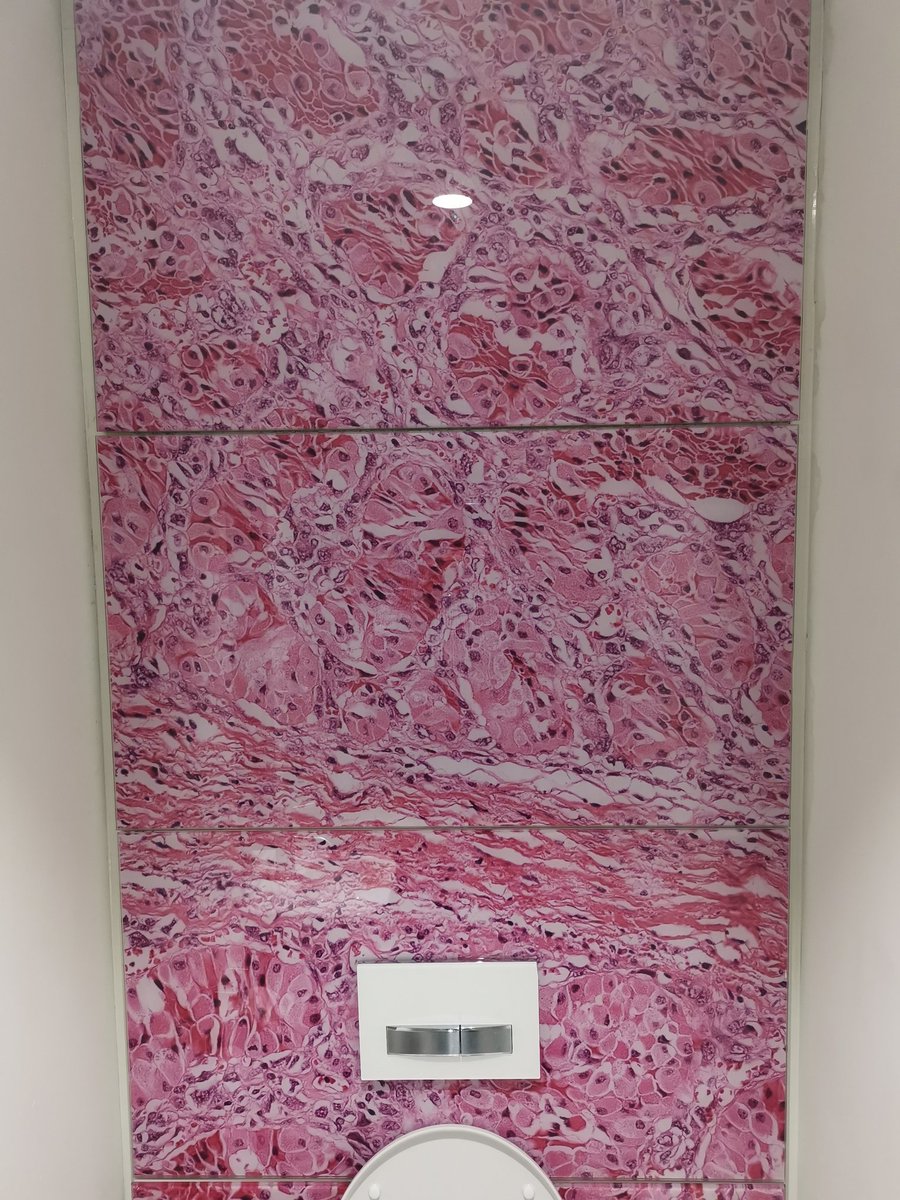RahulADeb's tweet photo. Only @RCPath can we have toilets like these. Simply brilliant! What's the diagnosis? ... An alveolar soft part sarcoma? Disclaimer.... I'm not a soft tissue pathologist! π. https://t.co/83OY2GRxPo