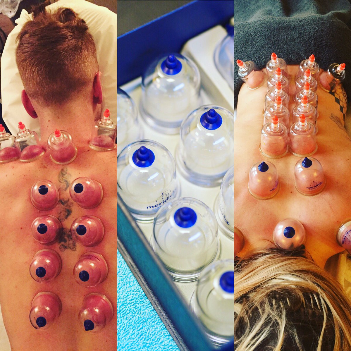 TreeRoomTreatme's tweet photo. Cupping Massage - relief for those niggling shoulders, lower back pain and help you get your next PB  ! 🏋️‍♀️#cuppingtherapy #shoulderpain #jesmond #newcastle #lowerbackpain #crossfitnorthumbria #crossfitgaia #crossfitglacier https://t.co/B6rP5VaJ67