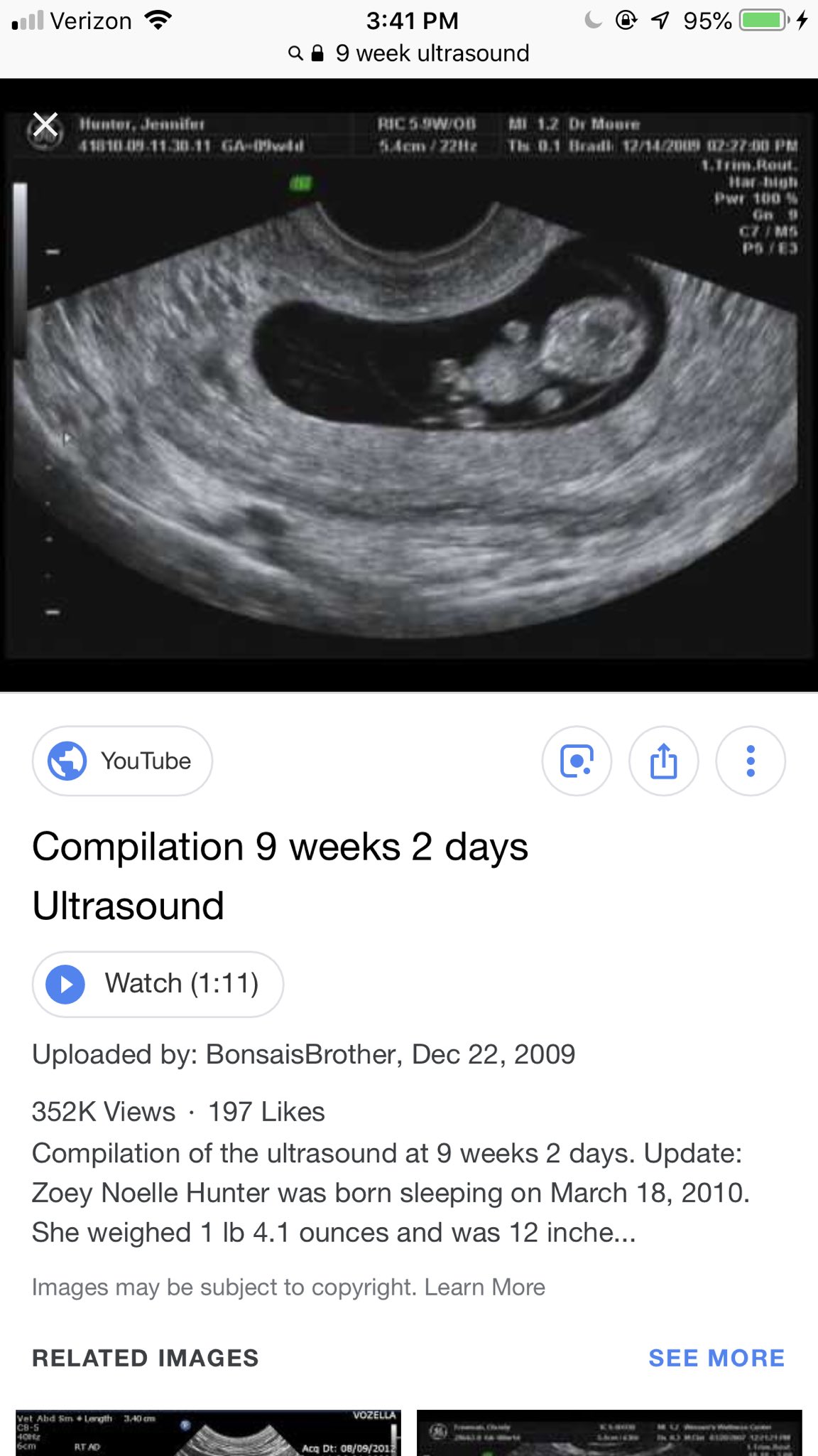 Ultrasound expect at 9 week what to 12 Things