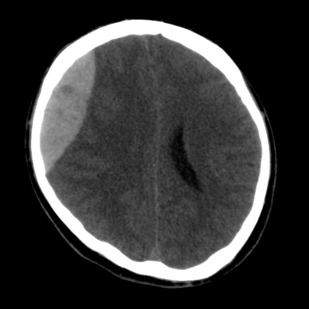 RadiologySigns's tweet photo. Q: What fruit is used to describe the shape of this pathology?
ANSWER: https://t.co/kotYEDWbl4 #FOAMrad #FOAMed https://t.co/QT3nut5tKM