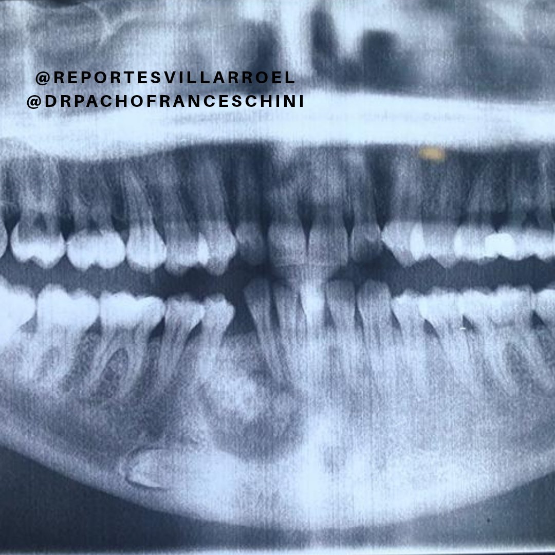 calcifying odontogenic cyst radiographic