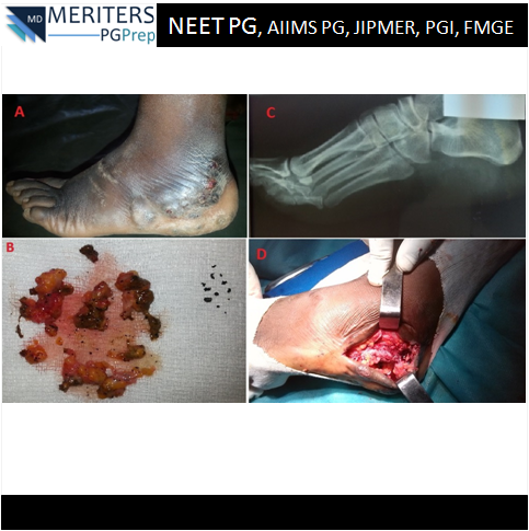 pg_prep's tweet photo. What is your diagnosis?
1. Charcot´s foot
2. Mycetoma pedis
3. Bowen´s disease
4. Kaposi sarcoma 
.
.
#NEET_PG #AIIMS #JIPMER #PGI #DNB #Medicine #PG_Medical_Entrance #NEETPG #MedicalEntrance #Doctor #Medical #PGPrep #ImageMCQs #NEET_Mock_Test #Anaesthesia #Biochemistry #ENT https://t.co/bcEVl0vb5N