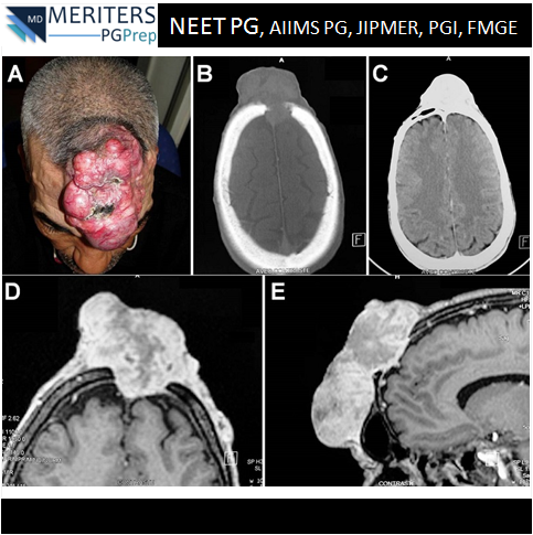 pg_prep's tweet photo. What is your diagnosis?
1. Cutaneous Melanoma
2. Keloid and Hypertrophic Scar
3. Dermatofibroma
4. Dermatofibrosarcoma
.
#NEET_PG #AIIMS #JIPMER #PGI #DNB #Medicine #PG_Medical_Entrance #NEETPG #MedicalEntrance #Doctor #Medical #PGPrep #ImageMCQs #NEET_Mock_Test #Anaesthesia https://t.co/p3b6GsMKOA