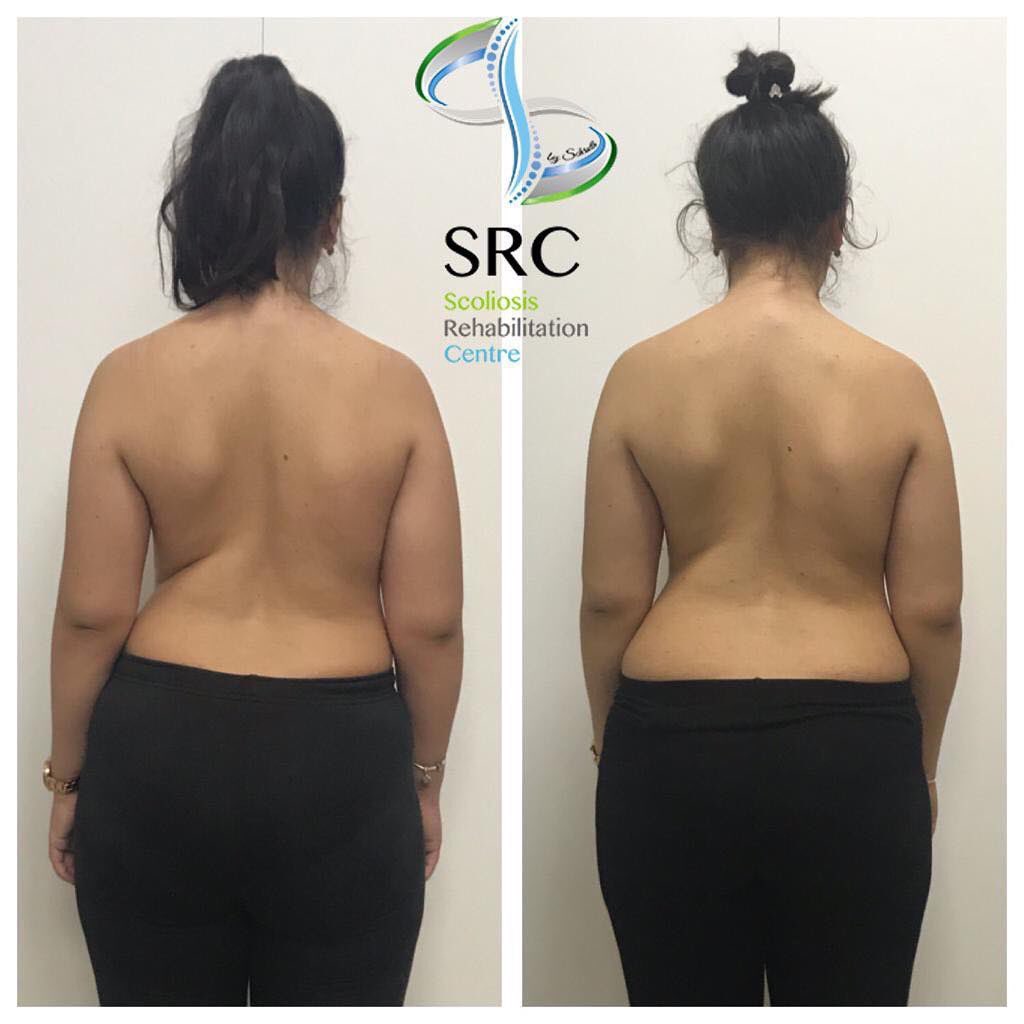 ScolioCentar's tweet image. Uvek je važno da smo na dobrom putu! Rezultati su naša snaga! ❤️ #scoliocentar #spine #schrothmethod #isstschroth #scoliocamp #scoliosis #skolioza #schrotheducation