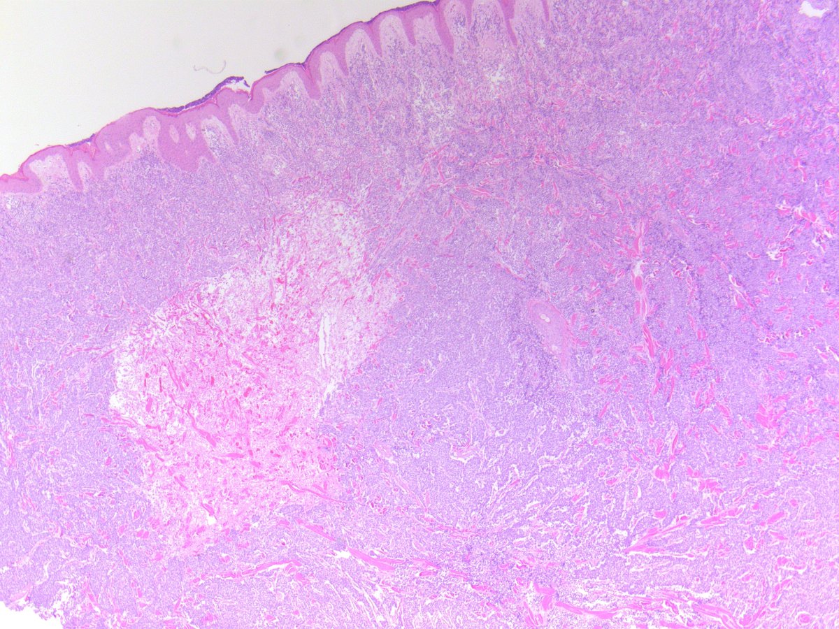 B_C_Dickson's tweet photo. EWING SARCOMA. NGS: EWSR1-FLI1. NB: this is a very rare location for primary presentation, and may be associated with a more favourable clinical outcome; sheets of small cells with scant cytoplasm; brisk mitotic activity; membranous CD99 (PMID: 9500772). https://t.co/jrieSu7A8e