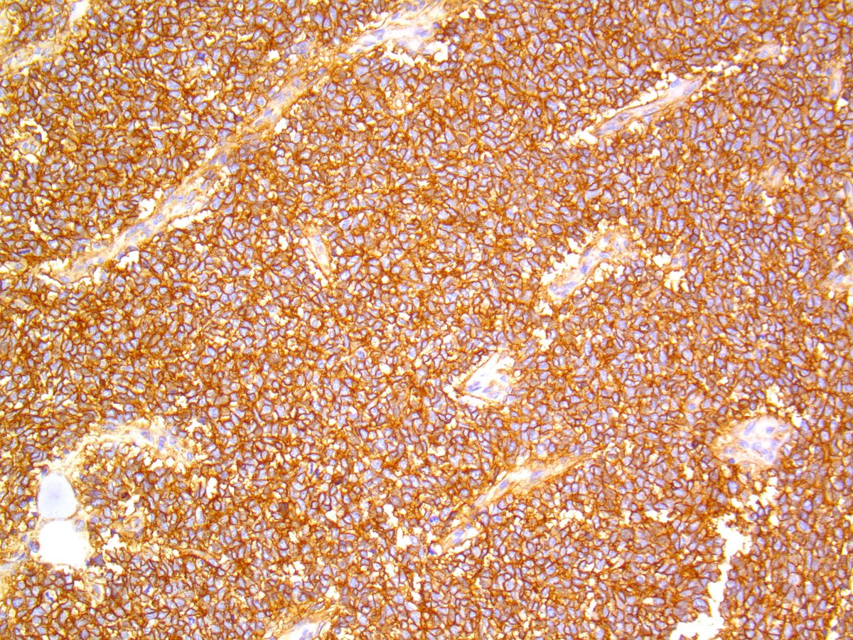 B_C_Dickson's tweet photo. EWING SARCOMA. NGS: EWSR1-FLI1. NB: this is a very rare location for primary presentation, and may be associated with a more favourable clinical outcome; sheets of small cells with scant cytoplasm; brisk mitotic activity; membranous CD99 (PMID: 9500772). https://t.co/jrieSu7A8e