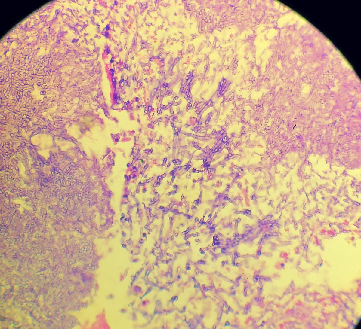 Who knew fungus could look this pretty #pulmonarypath #pathology #fungusball