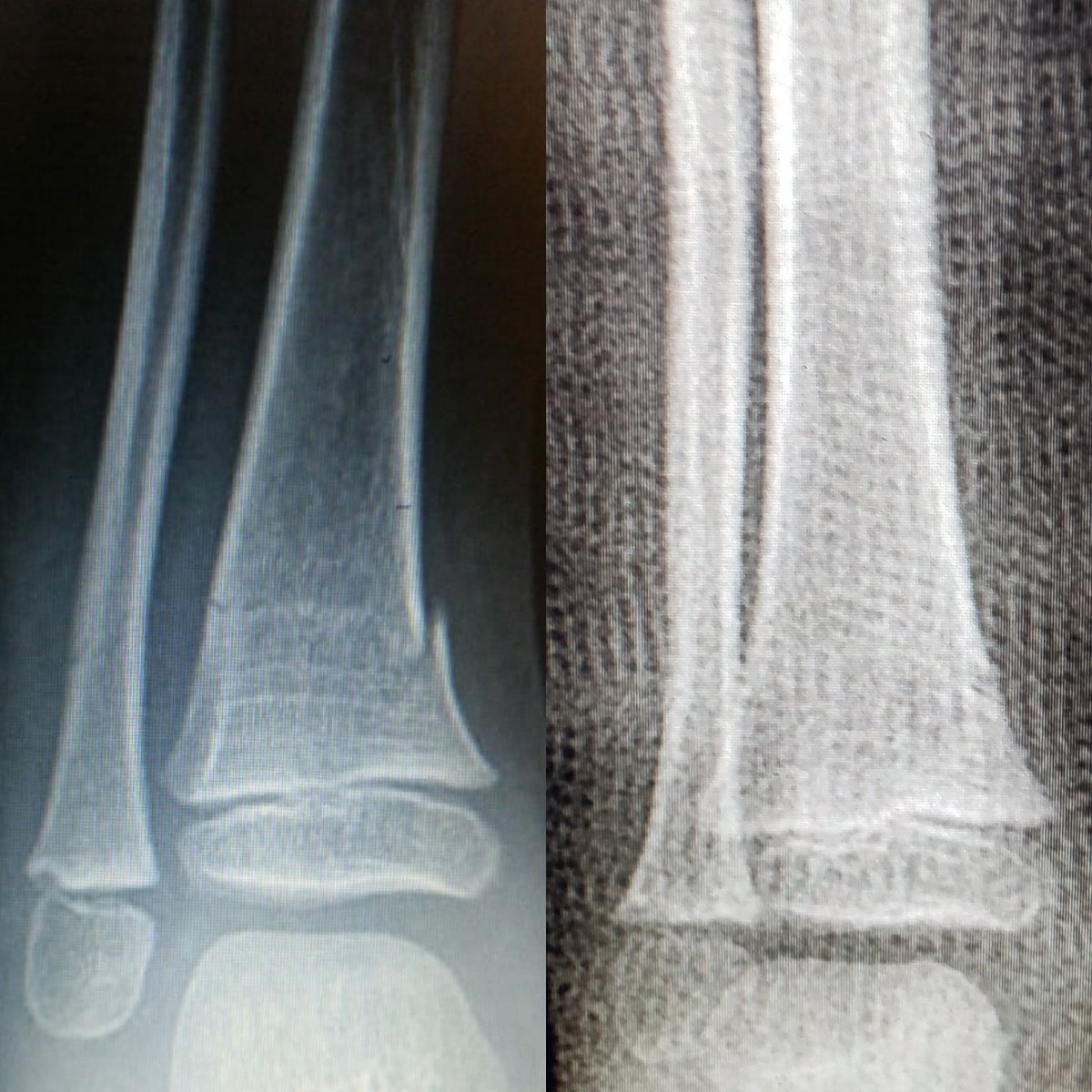 Traumapedia's tweet image. Fractura de metafísis distal de tibia peroné angulada en Varo en paciente Preescolar.
Tratamiento conservador. #sanoyeso #deltacast #deltadry #ortopediapediatrica #orthotraumateam #caetmei #hospitalstarmedicahip