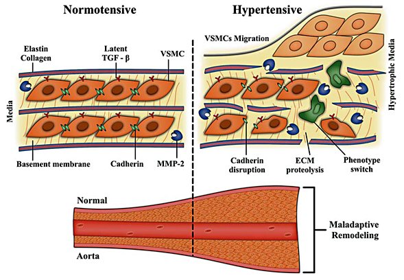 Matrix Metalloproteinase 2 as a Potential Mediator of Vascular Smooth Muscle Cell Migration and Chronic Vascular Remodeling in #Hypertension
👩‍⚕️Vanessa A. Belo <a href="/fmrpusp/">FMRP USP</a> <a href="/usponline/">USP - Universidade de São Paulo</a> 
📰karger.com/Article/Fullte… #MMP