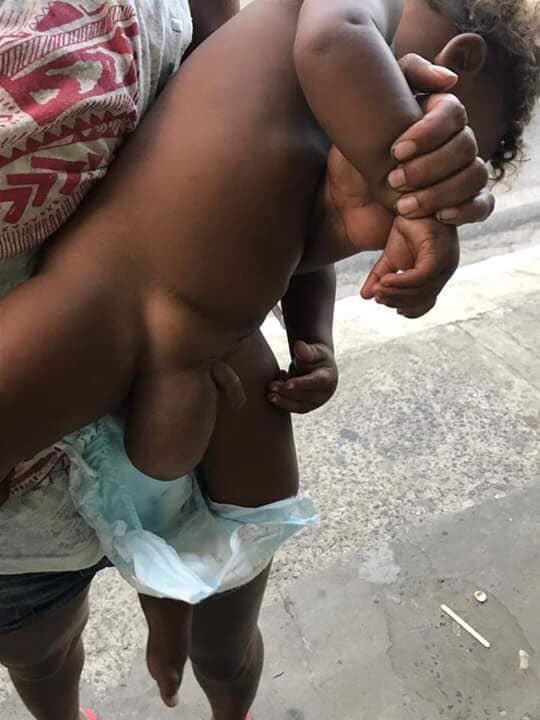 Raquelpinks2's tweet photo. Galera, li por alto q esta criança a qlqr momento o intestino pode ser perfurado devido a 1 hérnia no testículo. A mãe já foi em vários hospitais e n conseguiu. Ele sente mt febre e dores a noite. Engatinha c dificuldade. Qm puder, dar RT ou entre em Ctt c a mãe no tel 986617311. https://t.co/1eUpo5zcQL