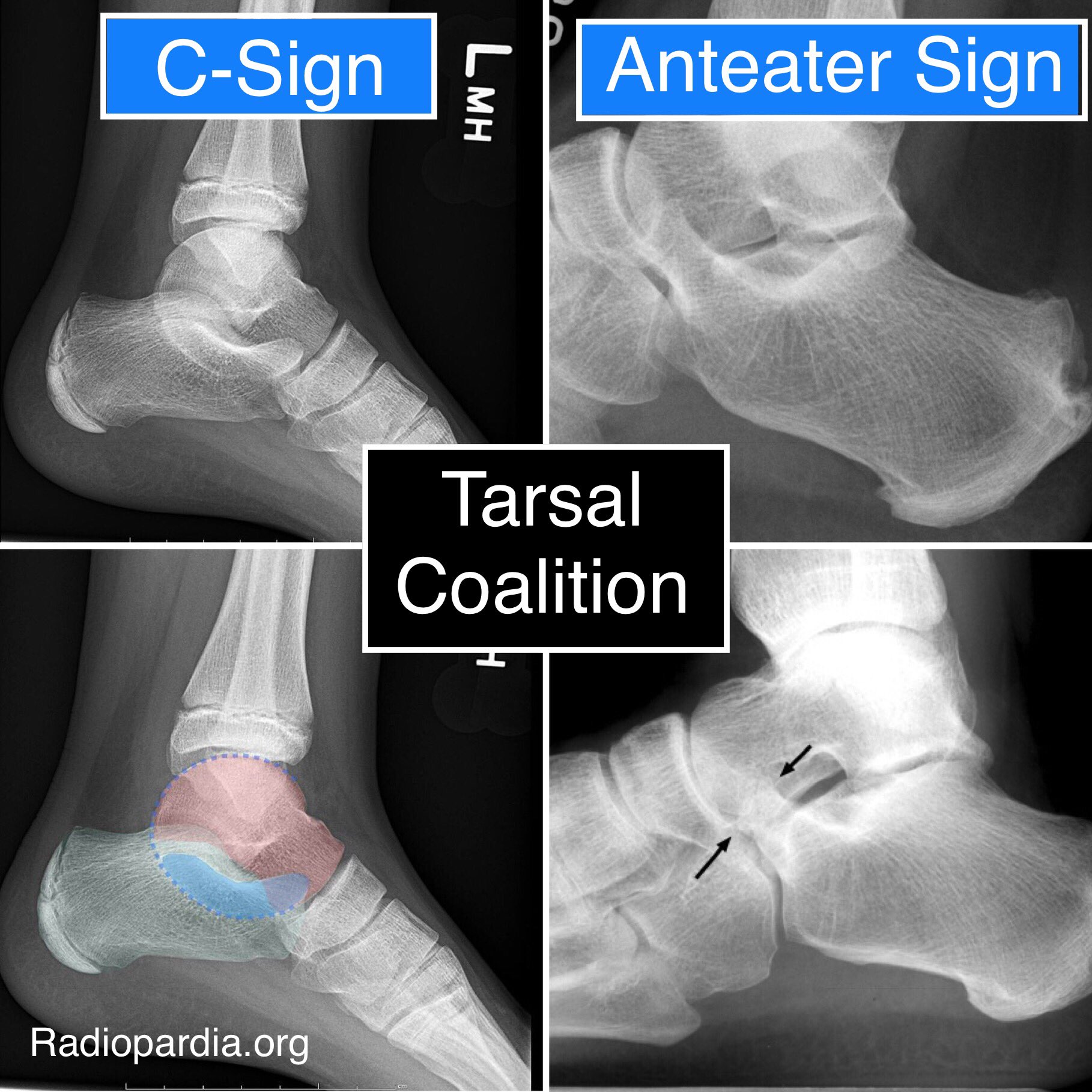 talocalcaneal coalition mri