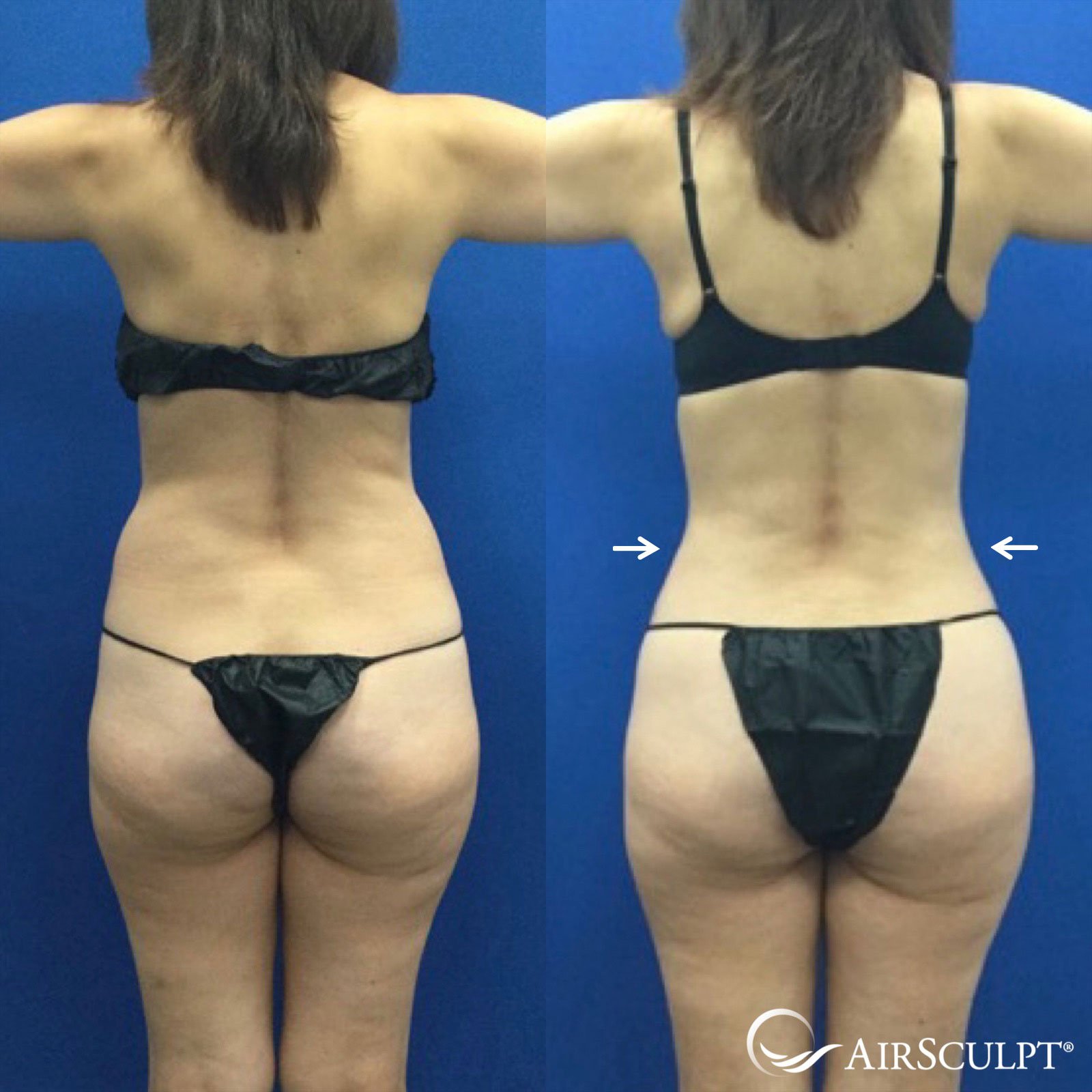 AirSculpt on X: This patient went from love handles to loving her