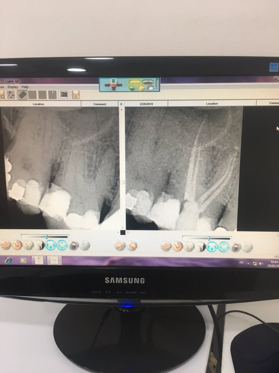 al_heresh's tweet photo. Root canal treatment upper 6 , single visit in 45 min ! @arabdentaljo #endo #endodontics #dentistry #amman #Jordan @BetterEndo @DentsplySirona #protaperGold https://t.co/93Hjudj8zR