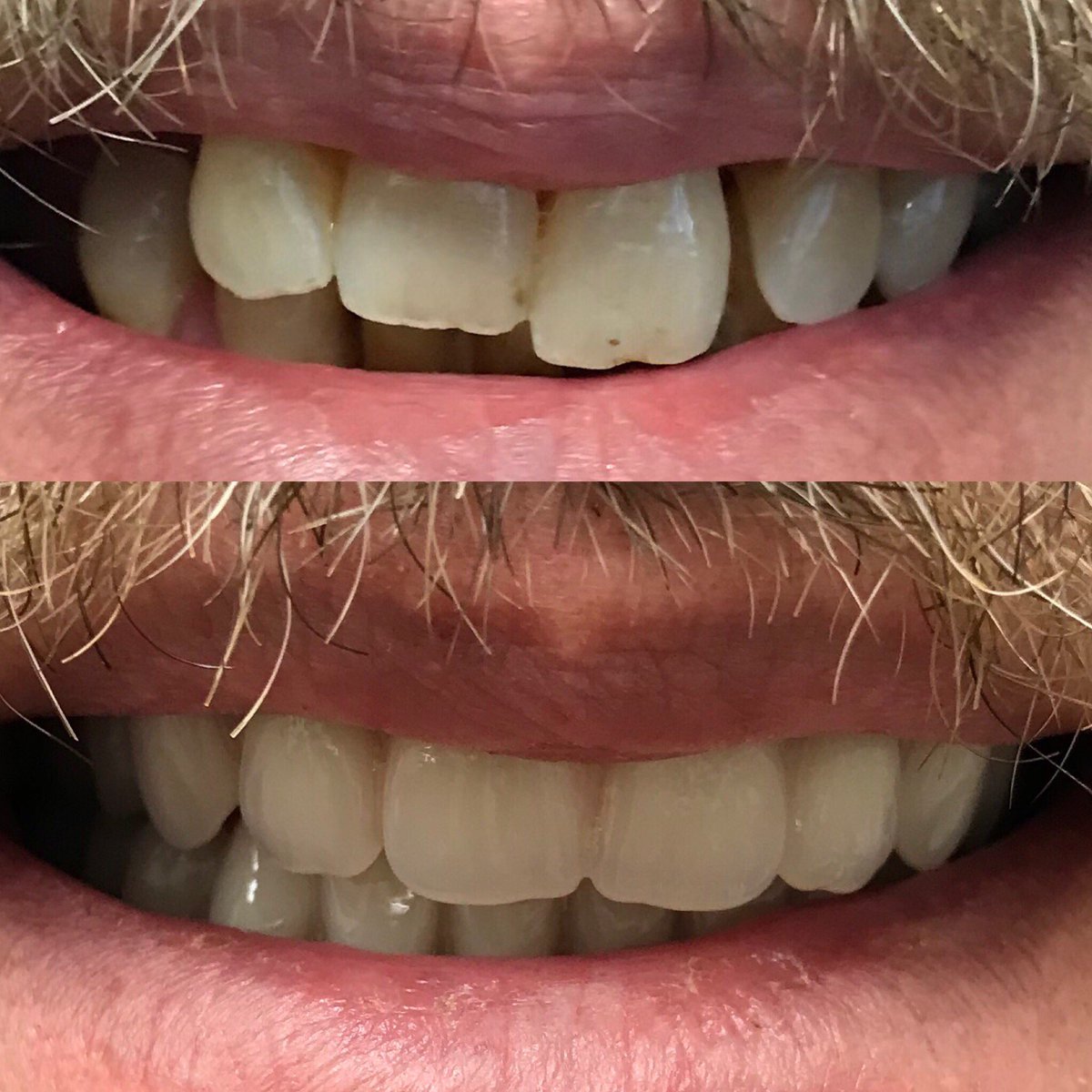 BEFORE &amp;AFTER. Are you losing your teeth, are you wearing dentures that are worn and no longer fit properly. Are you unsure of your options or what is available. Call us today for a free consultation. We will discuss your options &amp; work with you to restore your smile!