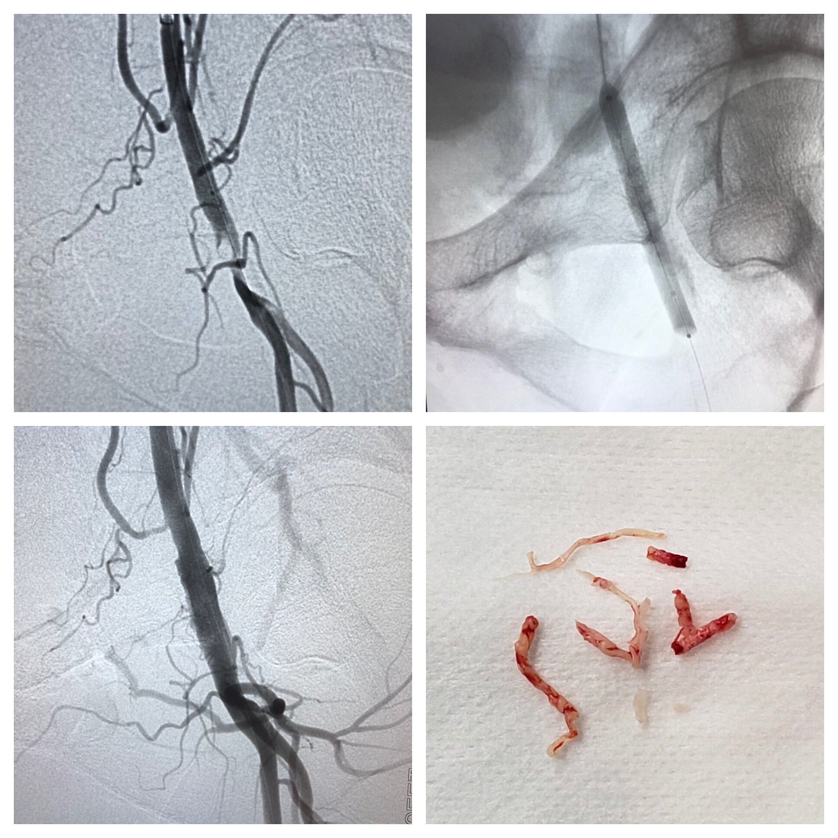 MTV_IR's tweet photo. 58 y/o M w/L leg #claudication. #HawkOneLS &amp; #Shockwave assisted directional #atherectomy. Significant plaque removal &amp; excellent flow post procedure. #mtvir #vascular #pad #miips #irad #cli #clifighters #wounds #dfw @Medtronic @drprestongs @sirrfs @acrrfs @clifighters https://t.co/yilJHen4xQ