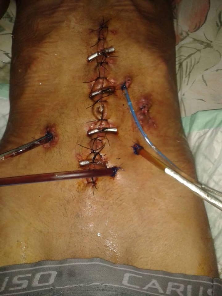 VenteDDHH's tweet photo. Juan Alcalá fue herido por arma de fuego el 22/12/2018. El proyectil perforó el hígado, intestino, estómago y se le extrajo un riñón. Sus familiares solicitan ayuda con urgencia para comprar NUTRICIÓN PARENTAL.

Para colaborar comunicarse al 04148132474 con Haidelys Alcalá. https://t.co/4DyEaXvg4F