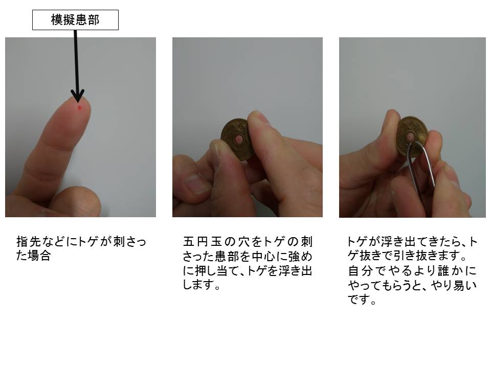 災害現場とかで有効 警視庁さんの トゲ抜きライフハック に目からウロコ でも昔からある方法でもあるので 先人の知恵はすごい Togetter 災害現場とかで有効 警視庁さんの トゲ抜きライフハック に目からウロコ でも昔からある方法でもあるので 先人の知恵はすごい Togetter