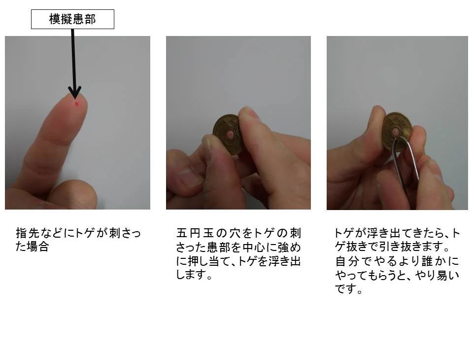 【知っておくと便利】お金を使って指の刺を抜く方法