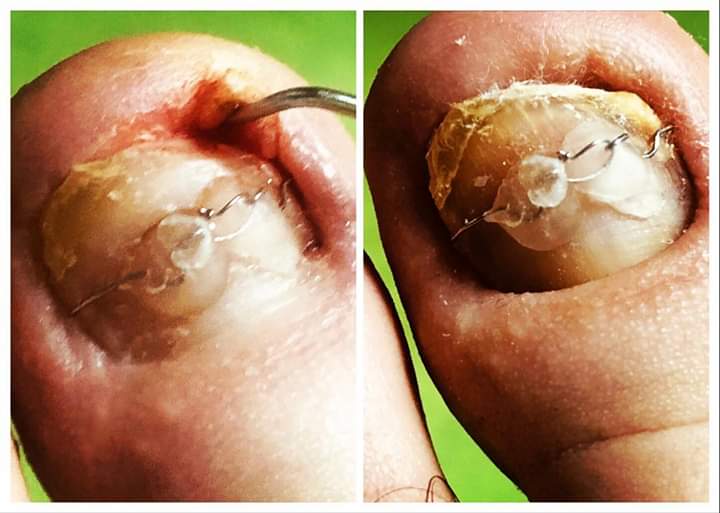 Yanlış kesimden kaynaklanan tırnak batması,erken müdahale ile ilk seansta normale döndü... İşimiz Podoloji,GÜCÜMÜZ Podoloji 🤗 #podoloji #podologie #podologia #podolog #ayaksağlığı #medikalayakbakımı #ayaksağlığımerkezi #ayaksagligiizmir #tırnakbatması #batıktırnak