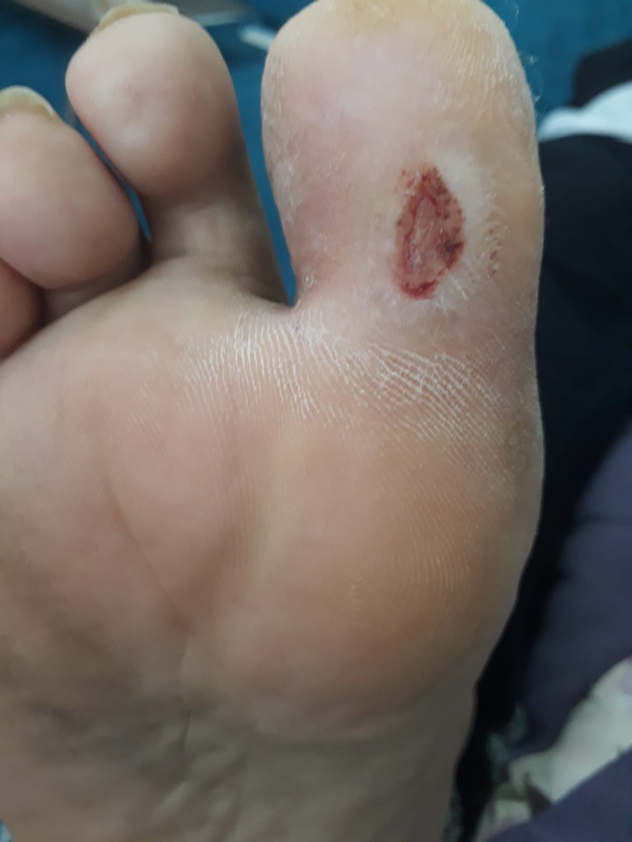 Diyabetik yara tedavi edilmesi