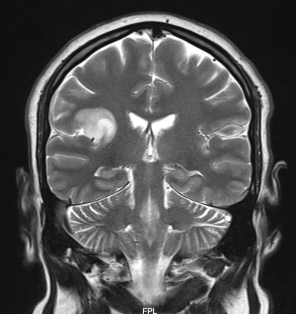 Rad_Bits's tweet photo. Quiz222: Thoughts?
#medschool #Medstudent #medical_student #medicaleducation #MedEd #foamed #FOAMrad #cardiotwitter #CardioEd #Cardiology #mrd13 #mrd14 #med15 #med16 #med102 #usmle #med20 #med19 #med18 #radcase #rsna18 #med101 #radiology #kku_med #uqumed #UQUMed35 #bu_medicine https://t.co/wGwNOBQuXb