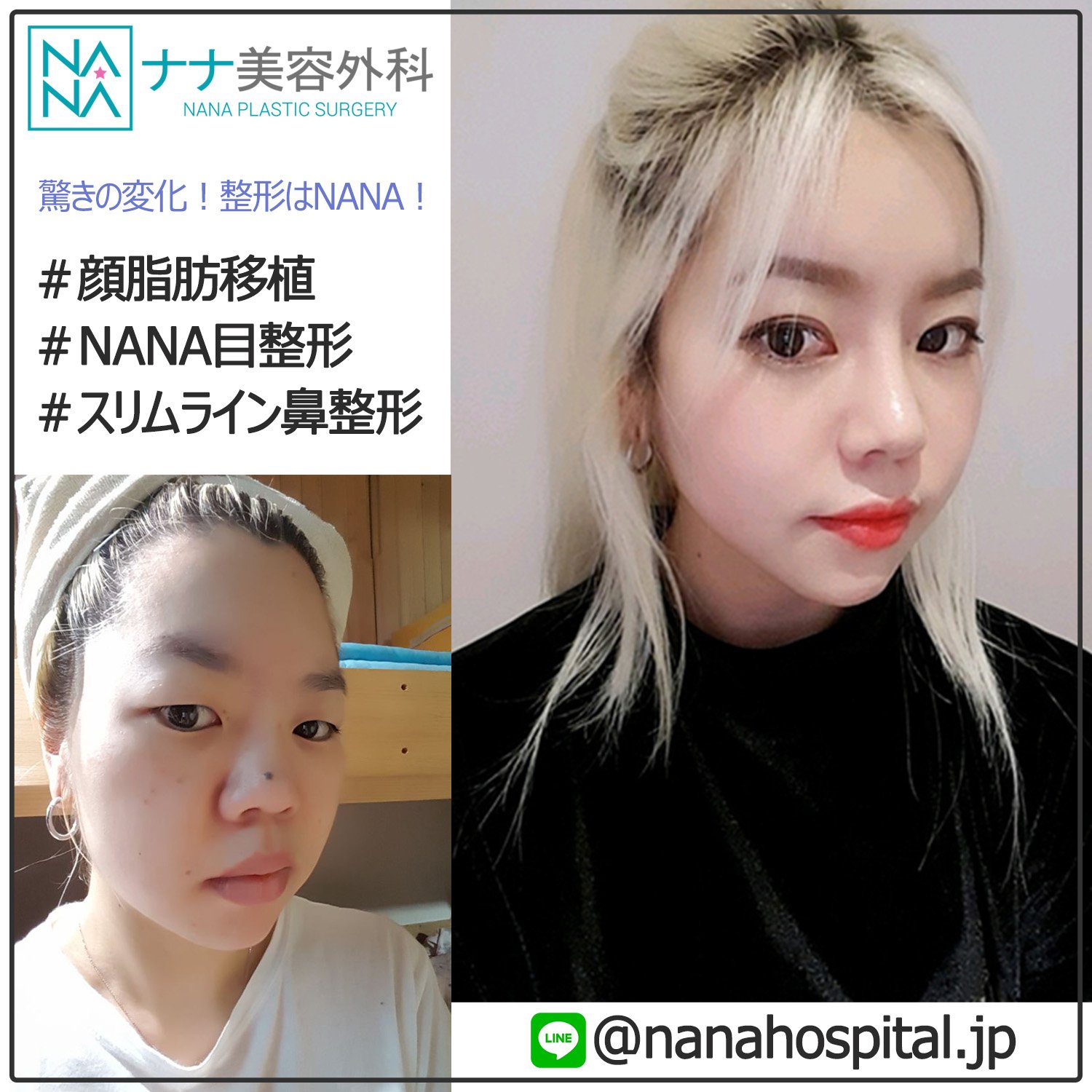 韓国nana美容外科 驚きの変化 もう団子鼻はサヨナラしましょう 安全に手術を受けられるように 医療軍 全スタッフが全力でサポートいたします 執刀医 キム ヒョンジュン Line Nanahospitai Jp 鼻整形 目整形 再手術 韓国整形 団子鼻 韓国nana美容外科 驚きの変化 もう団子鼻はサヨナラしましょう 安全に手術を受けられるように 医療軍 全スタッフが全力でサポートいたします 執刀医 キム ヒョンジュン Line Nanahospitai Jp 鼻整形 目整形 再手術 韓国整形 団子鼻