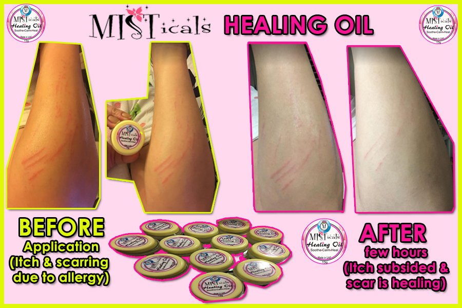 SprayMis's tweet photo. Real Results of An Organic and Botanical Healing Oil!! 🌱🌱💧💧

MISTicals powerful and effective oil that soothes and heals: itchy, irritated, overheated, inflamed, allergic, problematic, reddened skin, calms eczema and even helps remove warts naturally!! #misticals #Effective https://t.co/3ploGojyNu