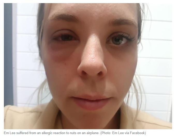 oakley_red's tweet photo. Em Lee suffered an allergic reaction aboard an airplane when she came into contact with nut residue that she believes was left on a plane seat or tray table from a previous trip https://t.co/7FJMaRiO2U https://t.co/Tos5nNPGk7