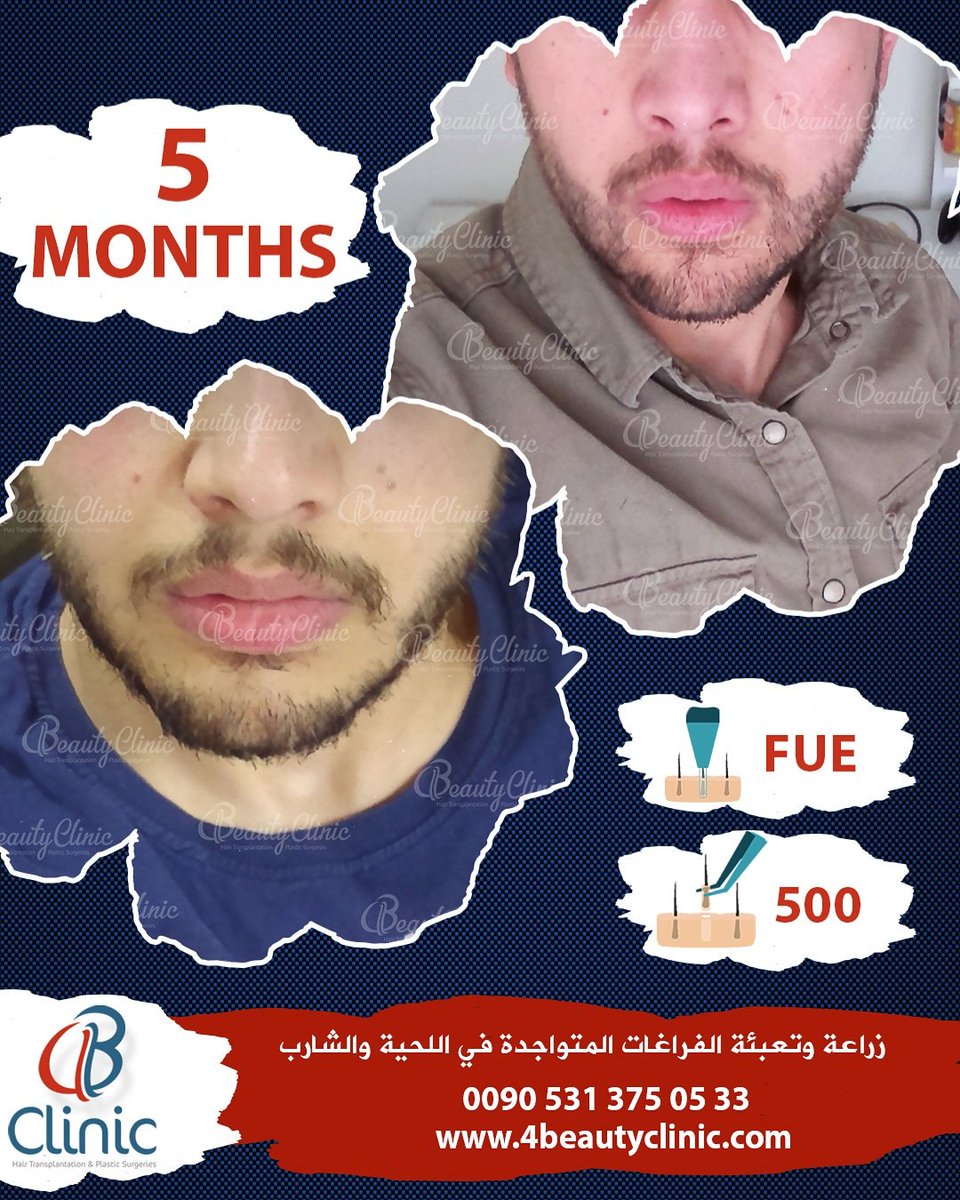 فور بيوتي كلينيك استعد شبابك معنا•
#زراعة_الشعر بأحدث التقنيات
• كادر طبي بخبرات عالية
• عروض مميزة 
#زراعة_اللحية 
#زراعة_الحواجب
#فندق 
#توصيلات 
#ضمان
#البلازما 
#PRP
للتواصل: 00905313750533 📲