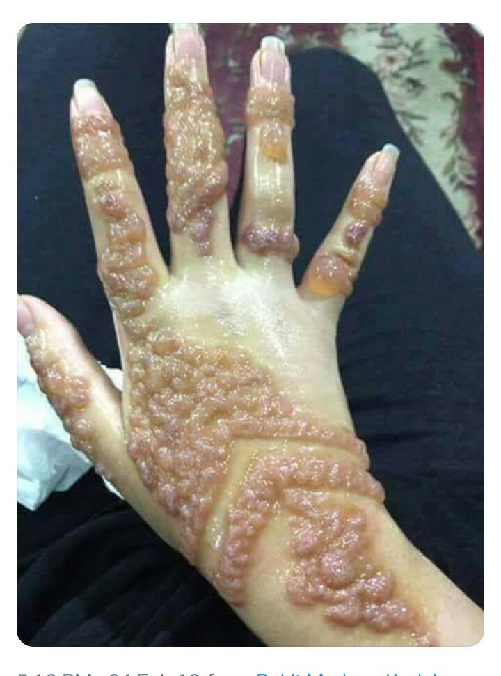 Faizzahri's tweet photo. Gara2 inai... Eeee... Bikin geli... Gunakan yang original plzzzz... 
#inaikawin
#sakitkulit https://t.co/WcddNVfcMR