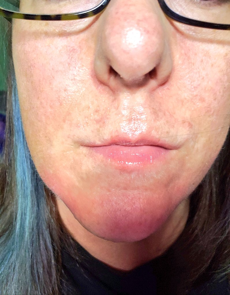 saintlov's tweet photo. I thought I'd try to be fancy and waxed my brows and upper lip Sunday.. then promptly broke out in red bumps.. yeah.. this is SO much better than a few fine hairs... (It's shiny from the steroid cream & polysporin.. so sexy!)
#BumpyPornStache
#NotObviousAtAll
#IDontFashionWell https://t.co/pEG2z3dcdo