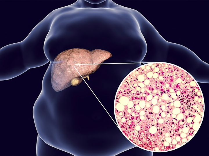 NeilFlochMD's tweet photo. #NASH Cirrhosis: #BariatricSurgery Helps, but Is It Worth Risks, Costs? | Medpage Today #obesityhttps://buff.ly/2GO1XgY https://t.co/mmIGBhydqq