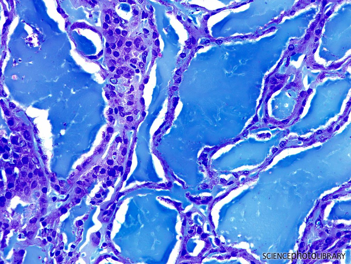 sciencephoto's tweet photo. Usually invisible to the human eye, this mesmerising image shows a light micrograph of thyroid cancer

Credit: J.L. Kemeny/ISM/Science Photo Library  https://t.co/6Bs88NZQY6 

#Abstract #LightMicrograph #Micrograph #Microscopy #thyroid #Science #Sciart #biology #artandscience https://t.co/F9poxDN0E8