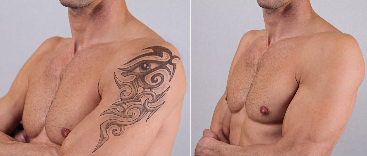 JackSonsj976's tweet photo. Get Rid of Unwanted Tattoos Naturally without Painful,
Expensive and Harmful Procedures https://t.co/l4pIX2sIA6 #tattoo #tattoos #tattooremove #laserlesstattooremoval https://t.co/FlbOu2QA79